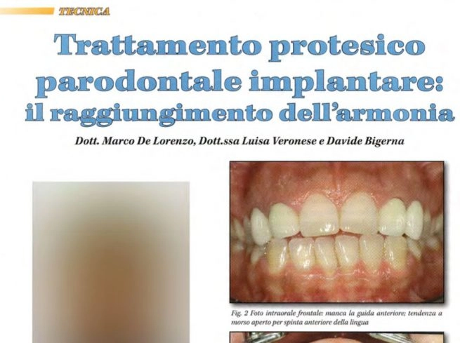 Trattamento protesico parodontale implantare